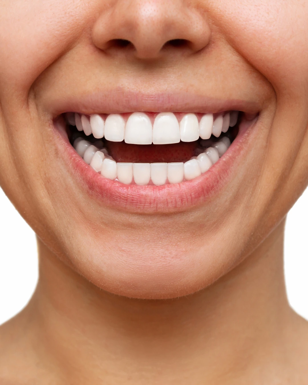 Dental Veneers After