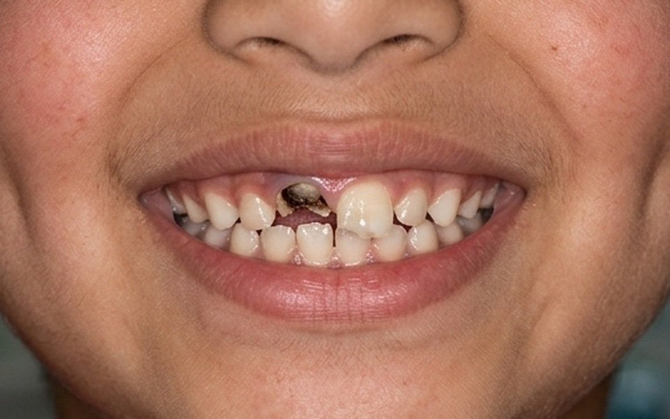 Pediatric Gentle Tooth Restoration Before