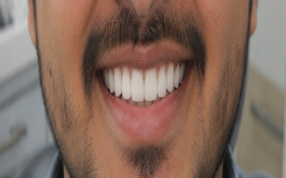 Aesthetic Smile Transformation After