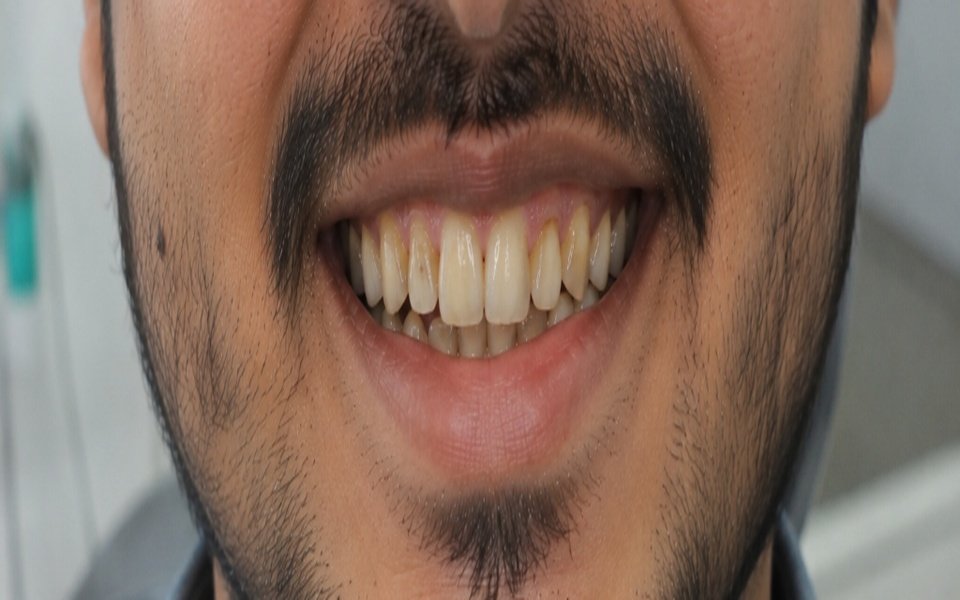 Aesthetic Smile Transformation Before