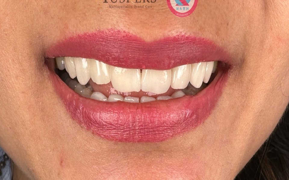 Crowns, Bridges & Dentures at Tuskers Dental