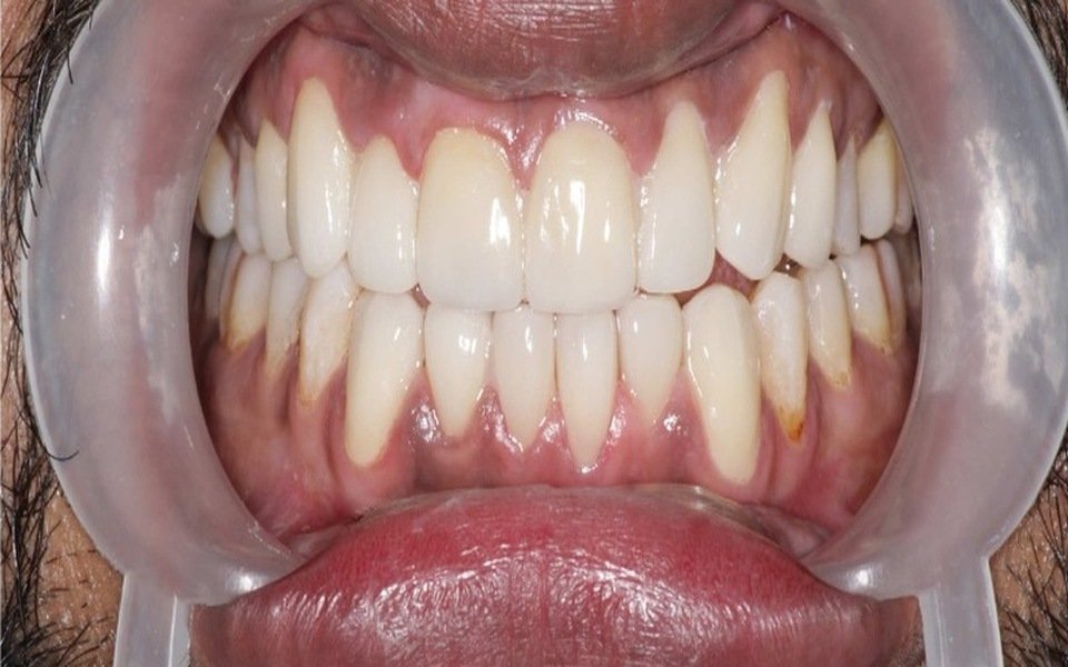Gum Disease Treatment at Tuskers Dental