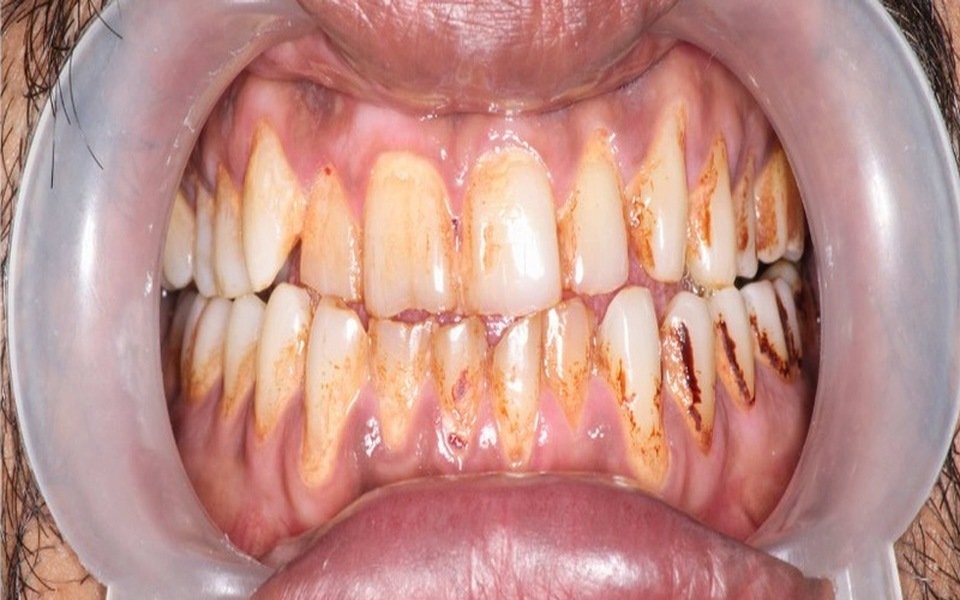 Gum Disease Treatment & Periodontal Scaling Before