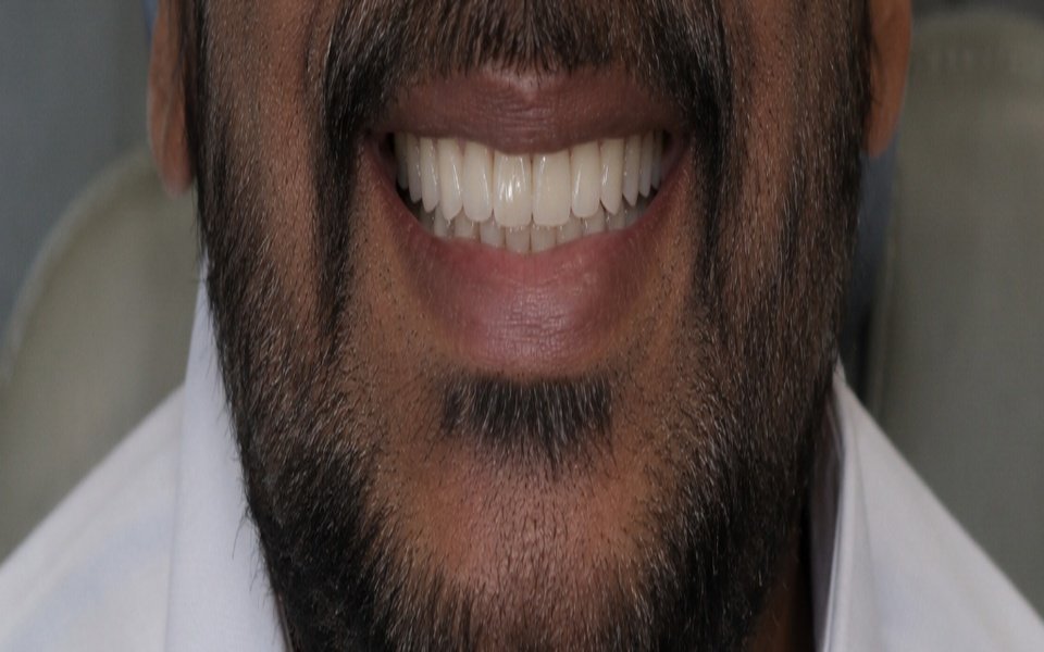 Dental Implant Tooth Replacement After
