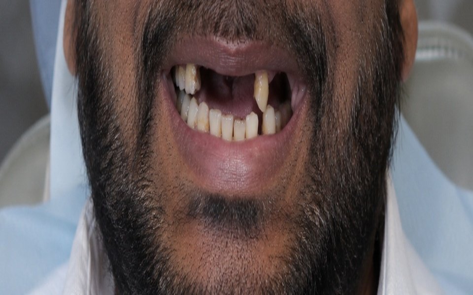 Missing Front Tooth Before Dental Implant