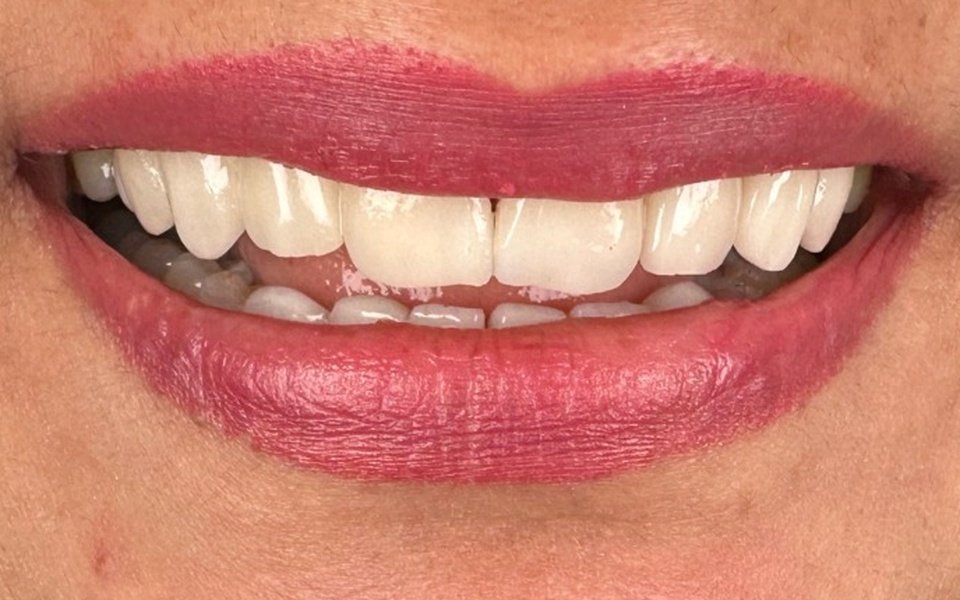 Invisalign Alignment After