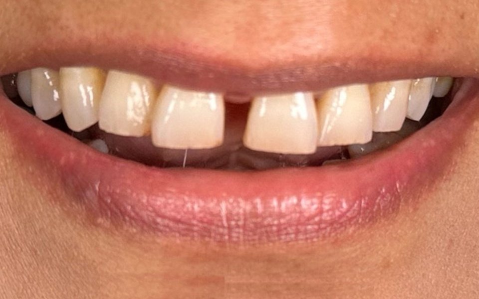 Invisalign Alignment Before