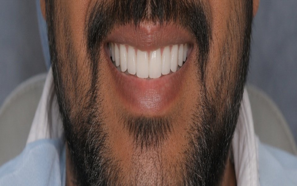 Smile Makeover After