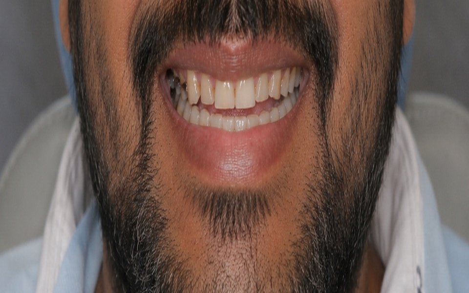 Smile Makeover Before
