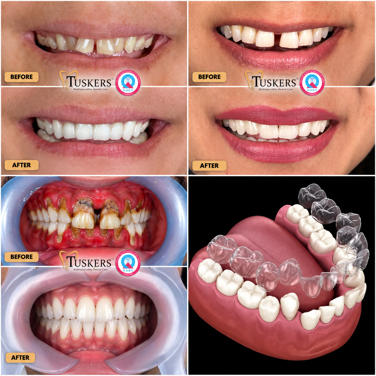 Tuskers Invisalign & Braces Smile Alignment Transformation Result