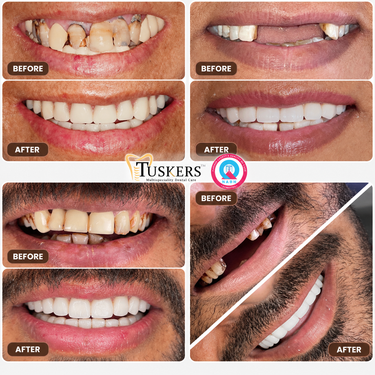 Tuskers Crowns and Bridges Full Smile Restoration Result