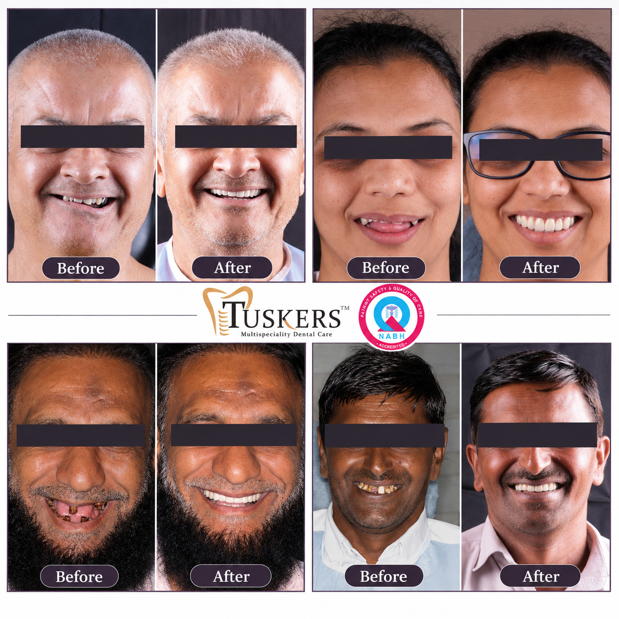 Tuskers Dental Implants Full Arch Transformation Before & After