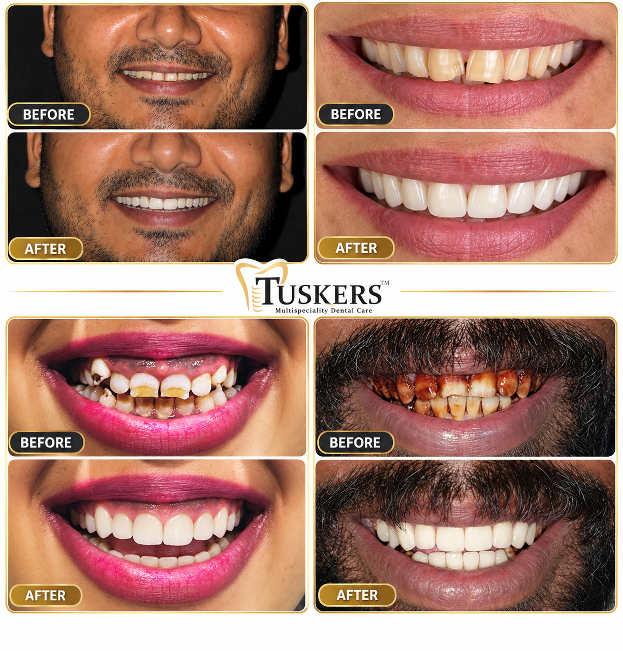Tuskers Clinical Smile Makeover Before & After Transformation Result