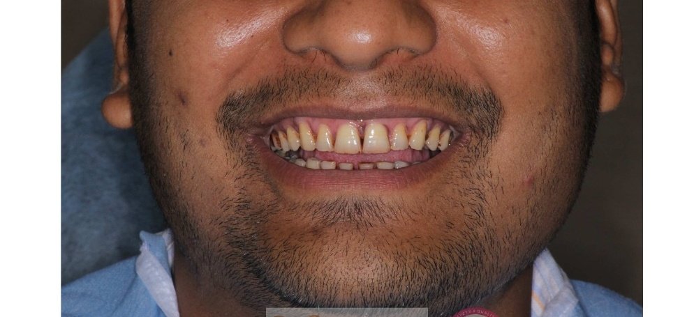 Teeth Midline Gap Diastema Before Treatment
