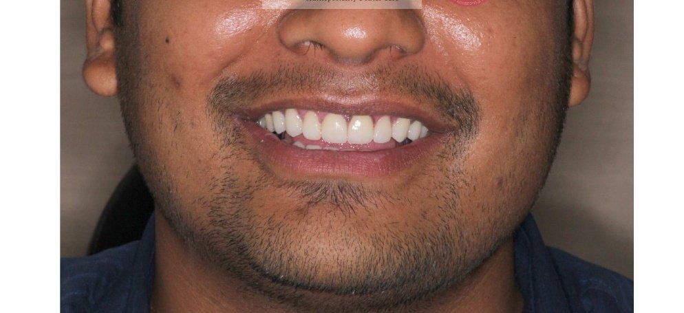 Seamless Diastema Closure and Aesthetic Alignment After Treatment