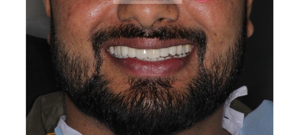 Full Mouth Ceramic Crown Smile Transformation After Treatment