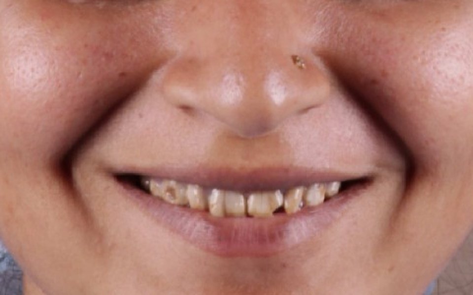 Deep Enamel Fluorosis and Staining Before Veneers