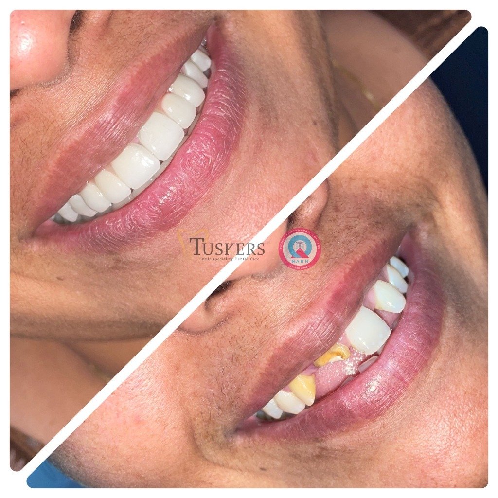 Aesthetic Smile Transformation Before and After at Tuskers Dental