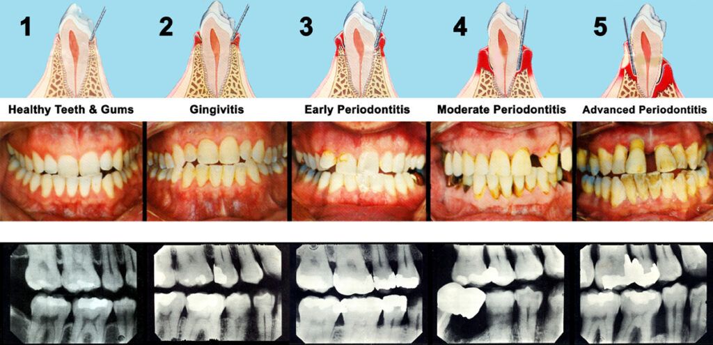 Gum Disease Treatment - Treatment of pyorrhea